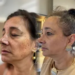 Comparação do rosto do paciente antes e após o tratamento de melasma, destacando a clareza e uniformidade da pele. Sucesso em tratamentos de melasma.